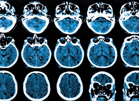 Neurodegenerative diseases | Science|Business